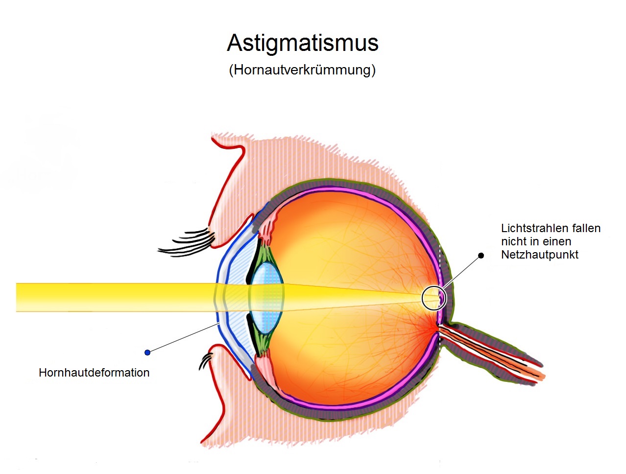 Auge mit Astigmatismus