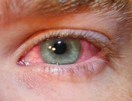 akútny syndróm červeného oka