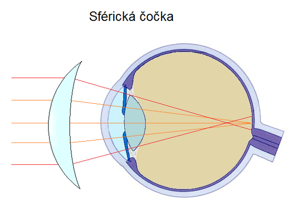 sférická aberace