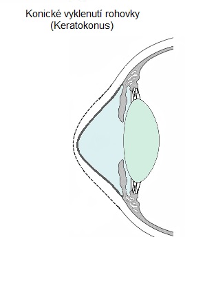 Keratokonus
