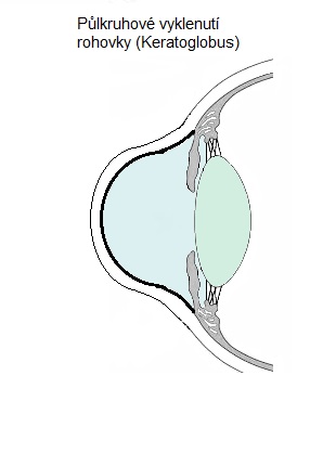 keratoglobus
