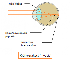 krátkozrakost