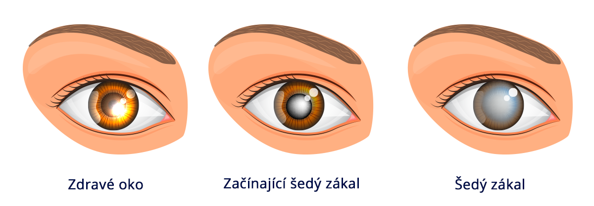 sedy-zakal