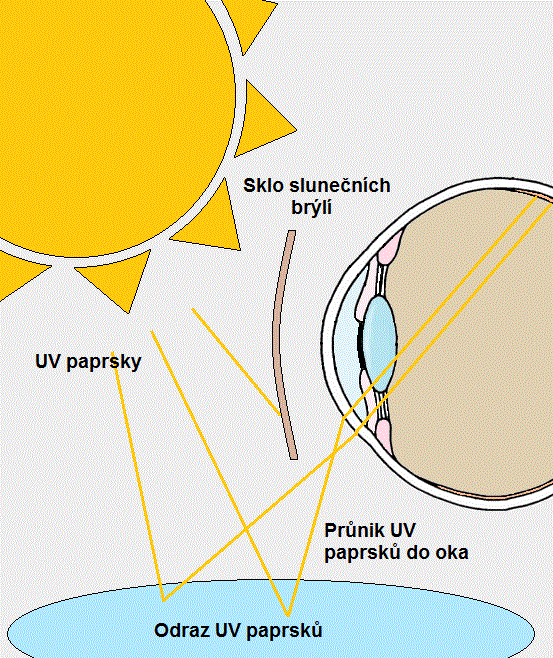 periférní fokusace bez kontaktních čoček